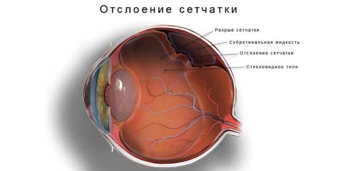 Перші симптоми погіршення зору