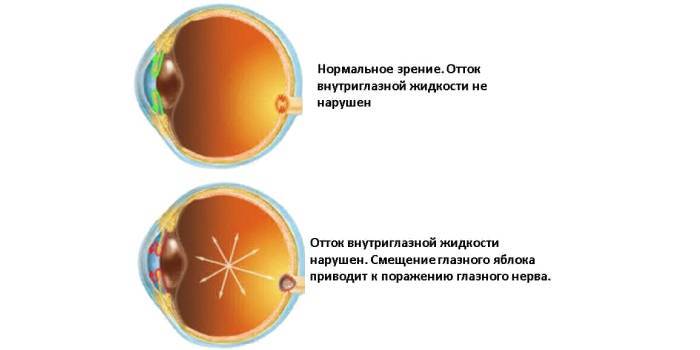 Перші симптоми погіршення зору